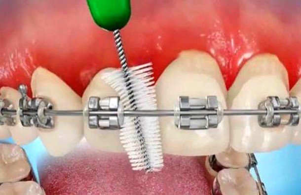 Không sử dụng lực quá mạnh khi chải kẽ răng